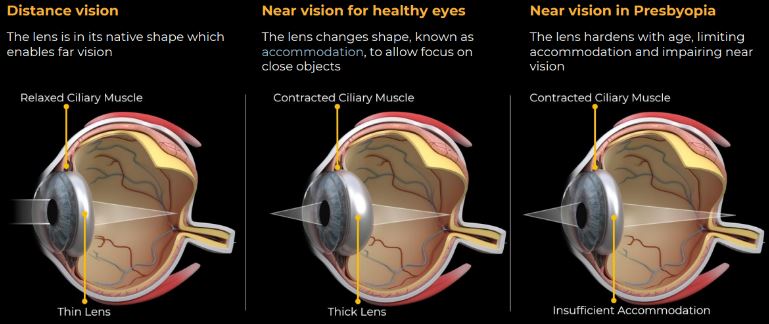 Presbyopes Have a Hardened/Inflexible Lens Which Limits Near Vision